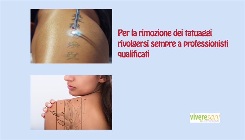 Eliminare un tatuaggio?